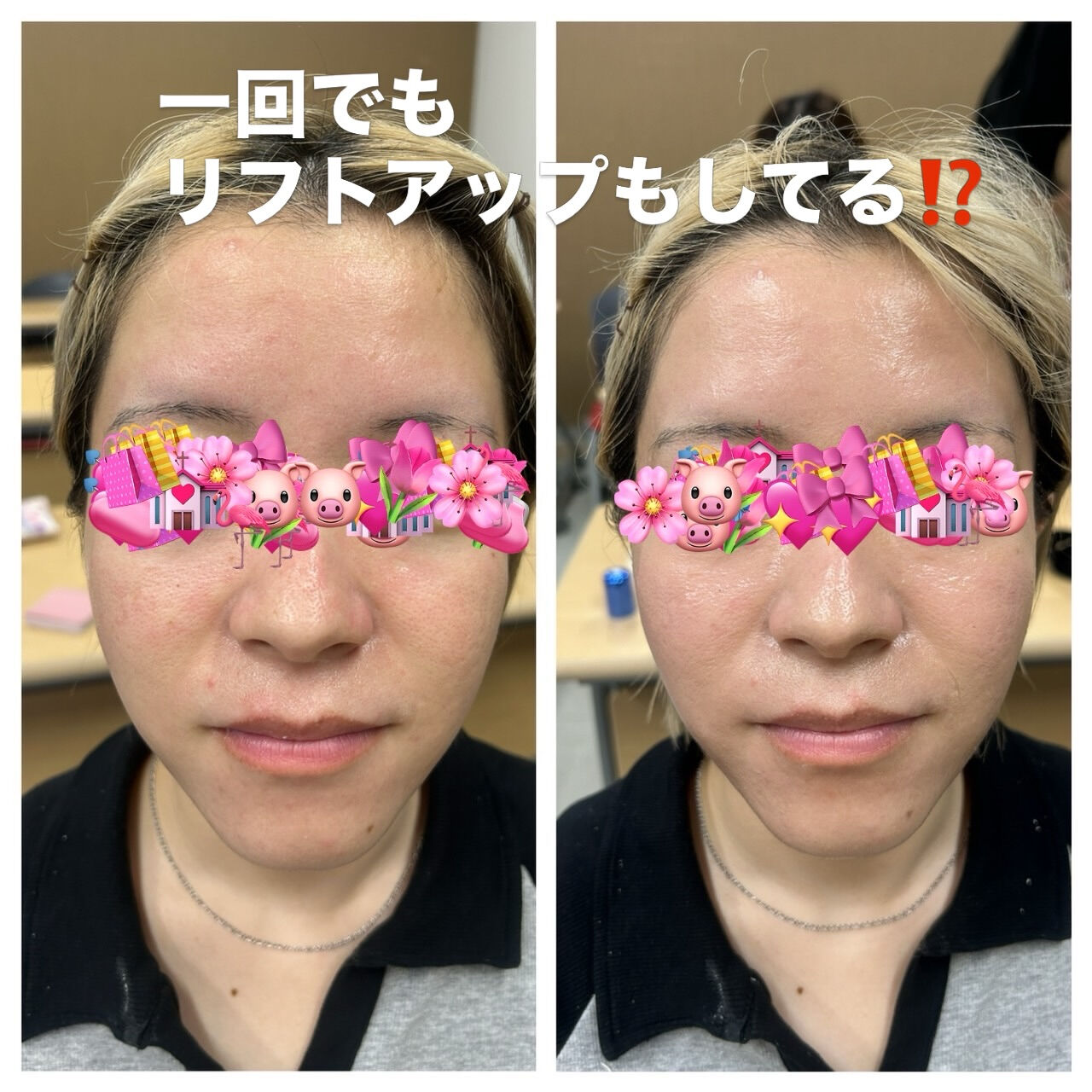【23歳・ダイヤモンドピール1回での驚きの変化✨】