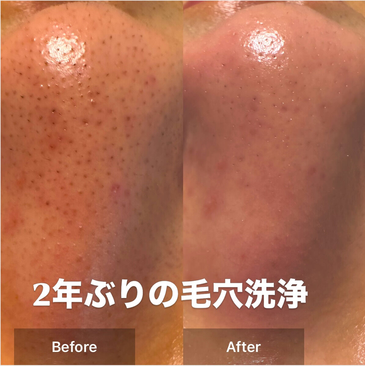 やっぱり毛穴の悩みはつきないよね😅