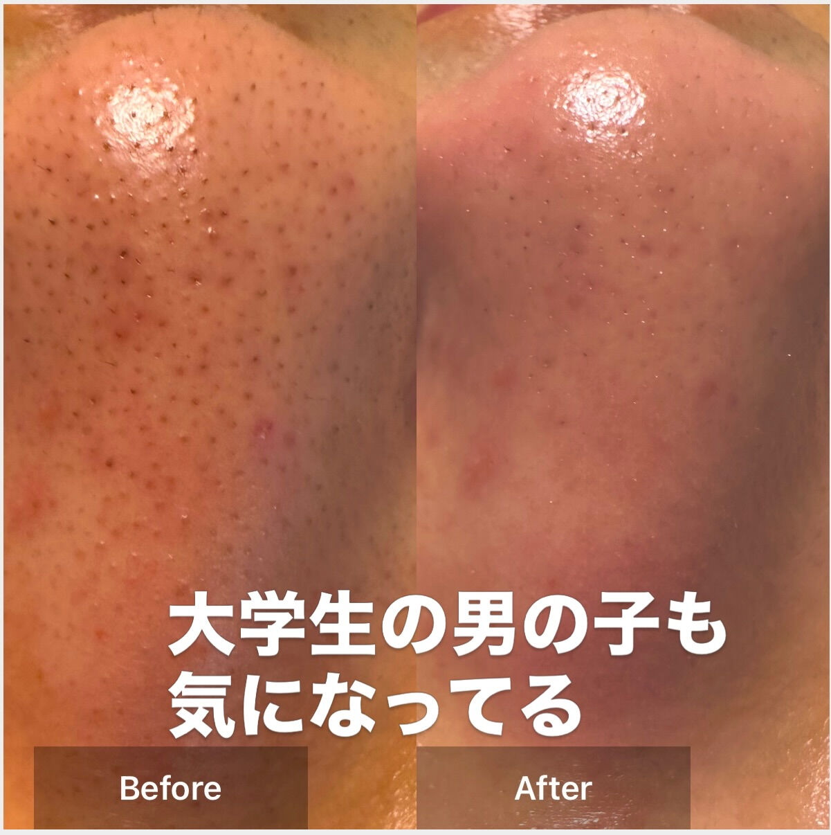 やっぱり毛穴の悩みはつきないよね😅