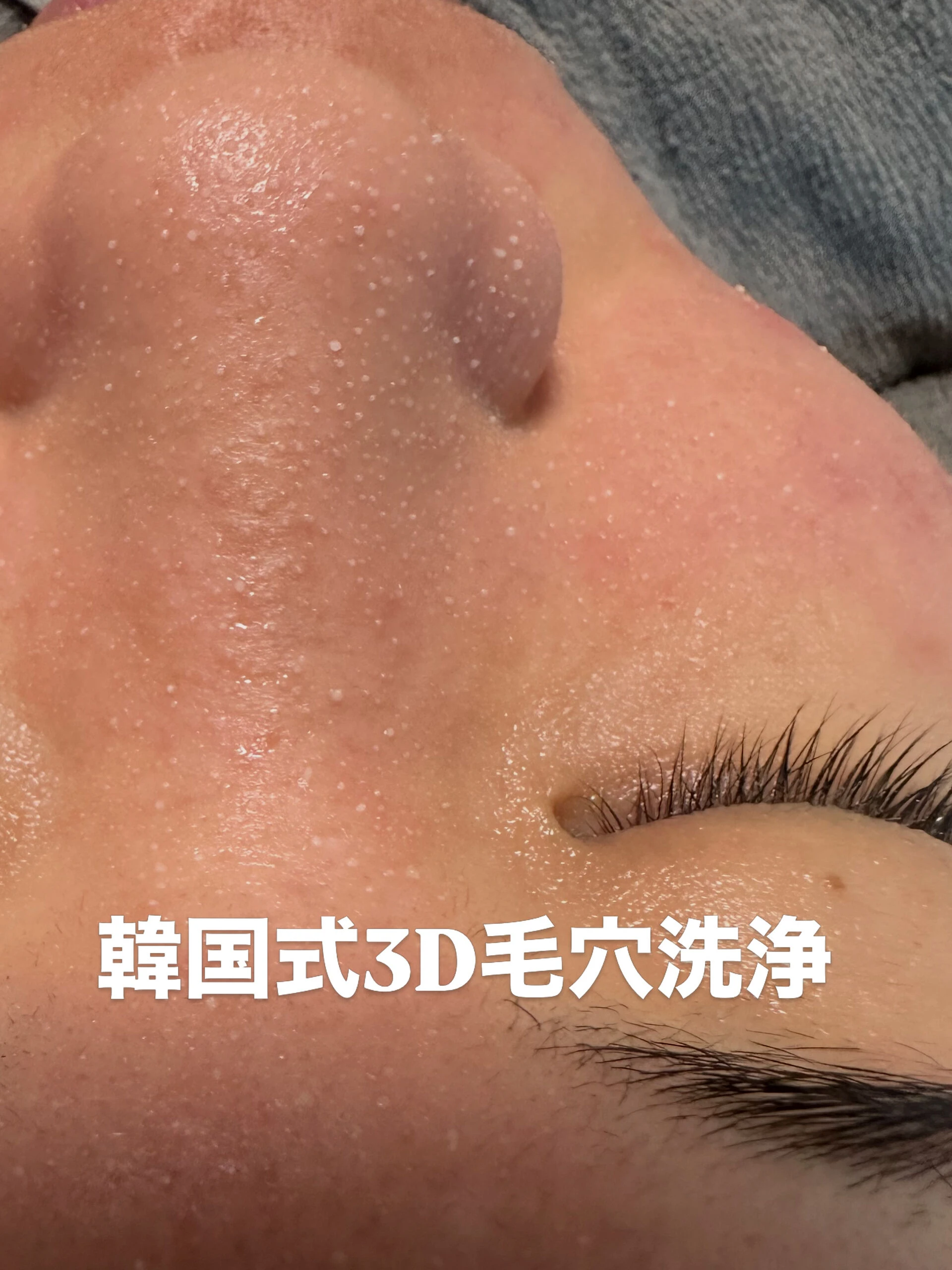 「何をしてもニキビが治らない…」