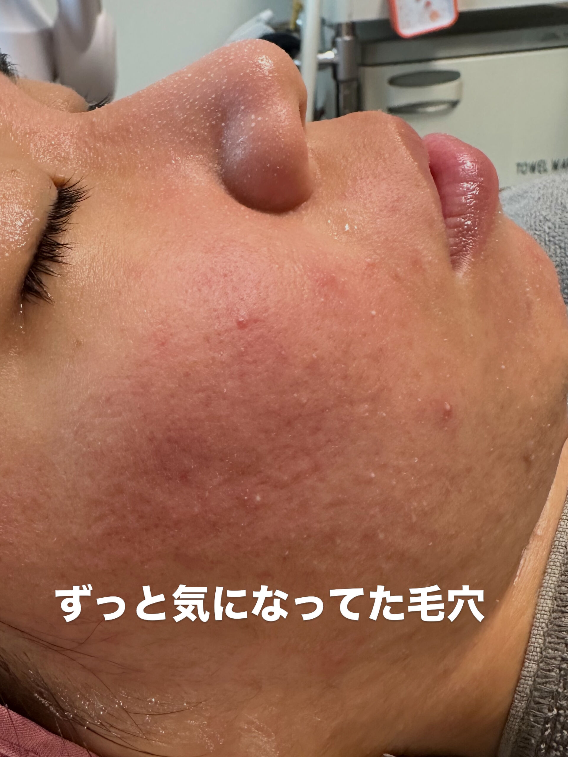 「何をしてもニキビが治らない…」