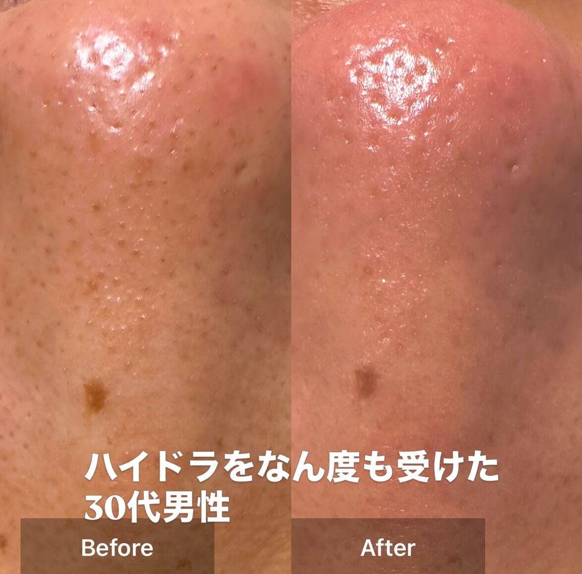 「ハイドラを何度か受けたけど、正直よく分からなかった」