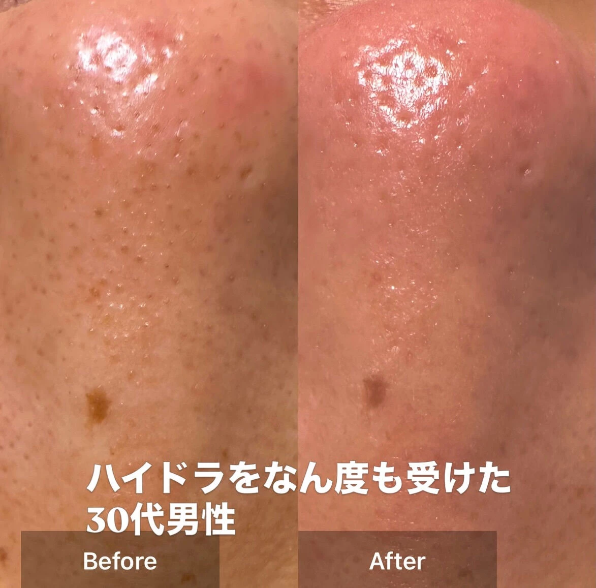 「ハイドラを何度か受けたけど、正直よく分からなかった」