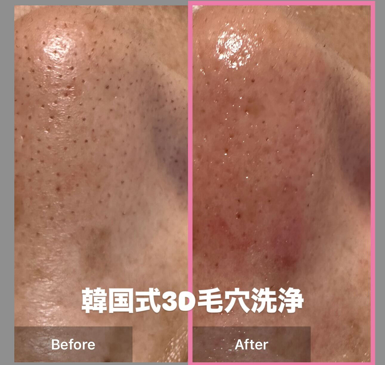 一度でこんなにキレイ😍気になっていたイチゴ鼻を一掃🧹