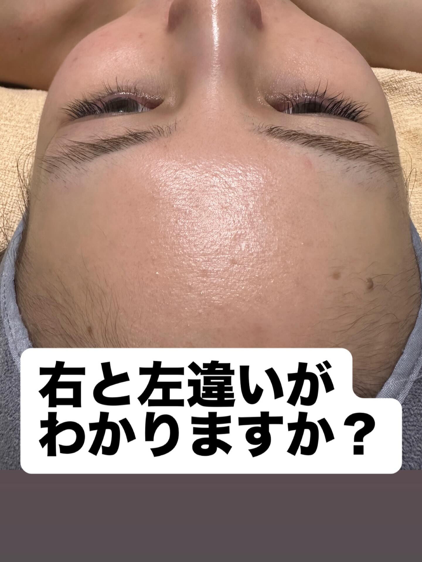 半顔のみジェルを塗布しました❣️